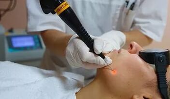 Un procedemento eficaz para eliminar papilomas da cara usando un láser