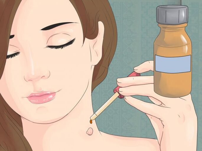 Use a droga en forma de solución para eliminar o papiloma do pescozo