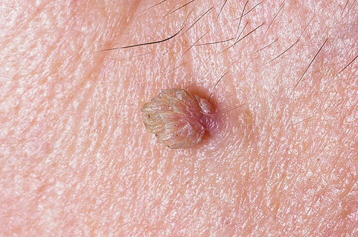Unha verruga na pel que se pode eliminar de moitas maneiras