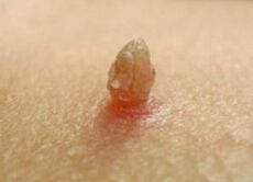 Papilloma afiado