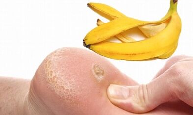 Bandexa de plátano para o tratamento dunha granxa plantar