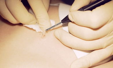 Eliminación cirúrxica da granxa plantar