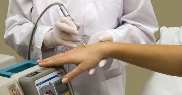 Cauterización con nitróxeno líquido