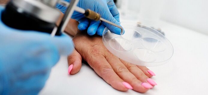 Verrugas no corpo humano