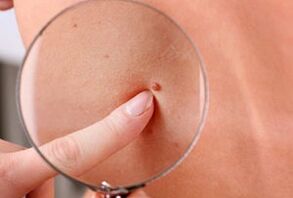 Razóns para a aparición de papilomas no corpo humano