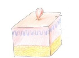 como desfacerse dos papilomas do corpo