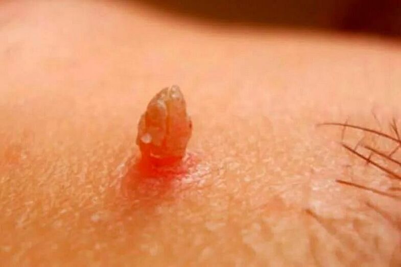 Verrugas xenitais no corpo
