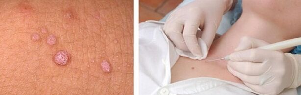 Eliminación profesional de papilomas no corpo