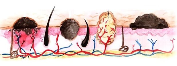 Tipos de papilomas no corpo humano
