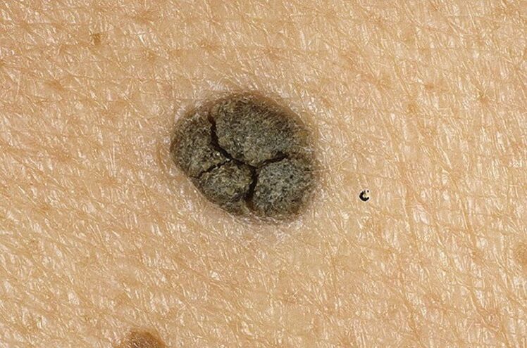 Queratoma na pel do corpo