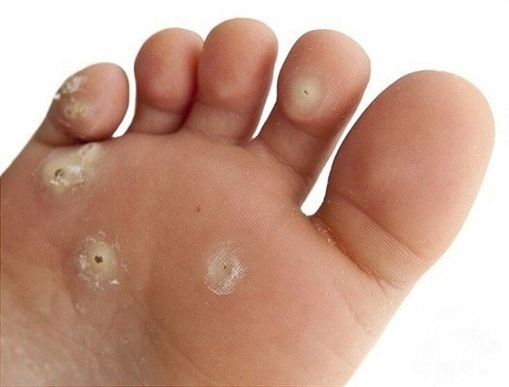 Verruga plantar