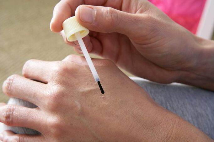 Cauterización de verrugas con zume de celidonia